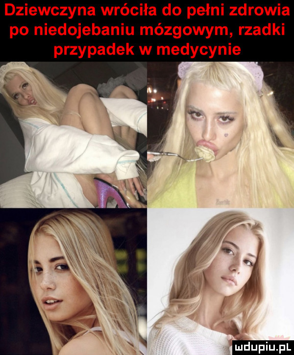 dziewczyna wróciła do pełni zdrowia po niedojebaniu mózgowym rzadki przypadek w medycynie