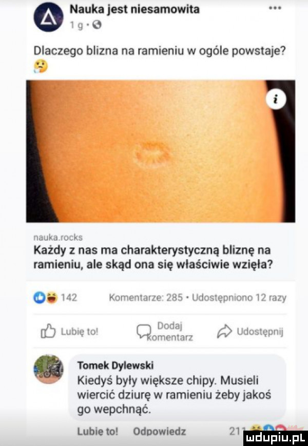 nauka jest niesamowita   g o dlaczego blizna na ramieniu w ogóle powstaje. nauka mks każdy z nas ma charakterystyczną bliznę na ramieniu ale skąd ona się wlaściwle wzięła oi     komemane     udosrepmono   a y dodaj   fb lublęm amemavz udoblęunrl. rokok wiew ki kiedyś były większe chipy. musieli wiercić dziurę w ramieniu żeby jakoś go wepchnąć. lubie m odpowled    m