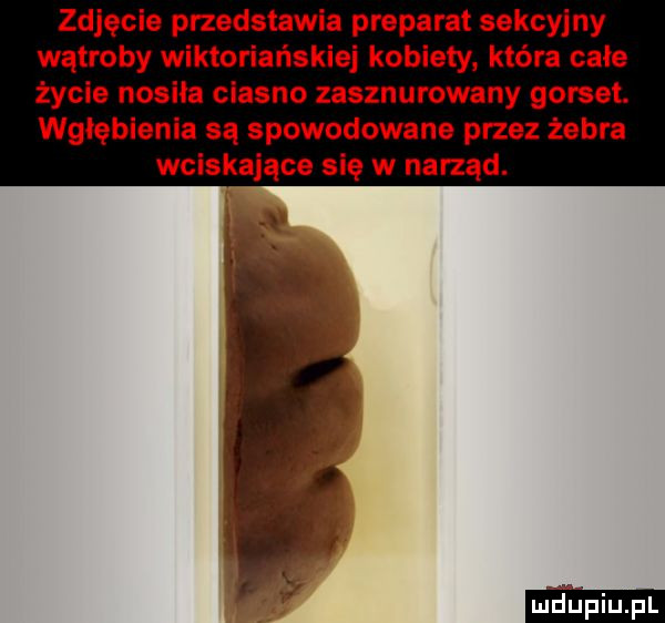 zdjęcie przedstawia preparat sekcyjny wątroby wiktoriańskie kobiety która całe życie nosiła ciasno zasznurowany gorset. wgłębienia są spowodowane przez żebra wciskające się w narząd