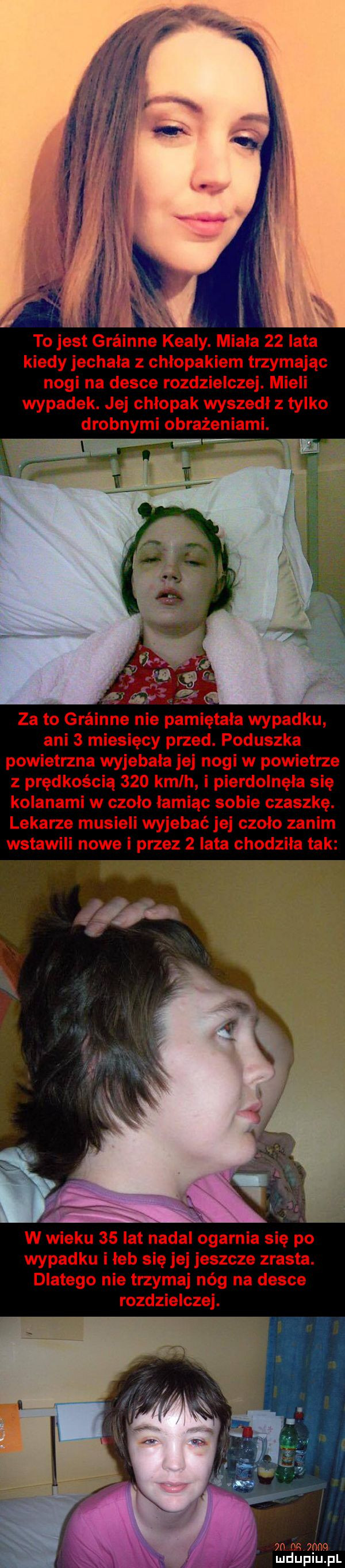 to jest grainne kelly. miała    lata kiedy jechała z chłopakiem trzymając nogi na desce rozdzielczej. mieli wypadek. jej chłopak wyszedł z tylko drobnymi obrażeniami. za to g ne nie pamiętała wypadku ani   miesięcy przed. poduszka powietrzna wyjebała jej nogi w powietrze z prędkością     kmlh i pierdolnęła się kolanami w czoło łamiąc sobie czaszkę. lekarze musieli wyjebać jej czolo zanim wstawili nowe i przez   lata chodziła tak  . w wieku    lat nadal ogarnia się po wypadku i leb się jej jeszcze zrasta. dlatego nie trzymaj nóg na desce rozdzielczej. mm  pm mduplu pl