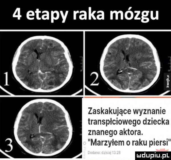 etapy raka mózgu zaskakujące wyznanie transpłciowego dziecka znanego aktora. marzyłem o raku piersi
