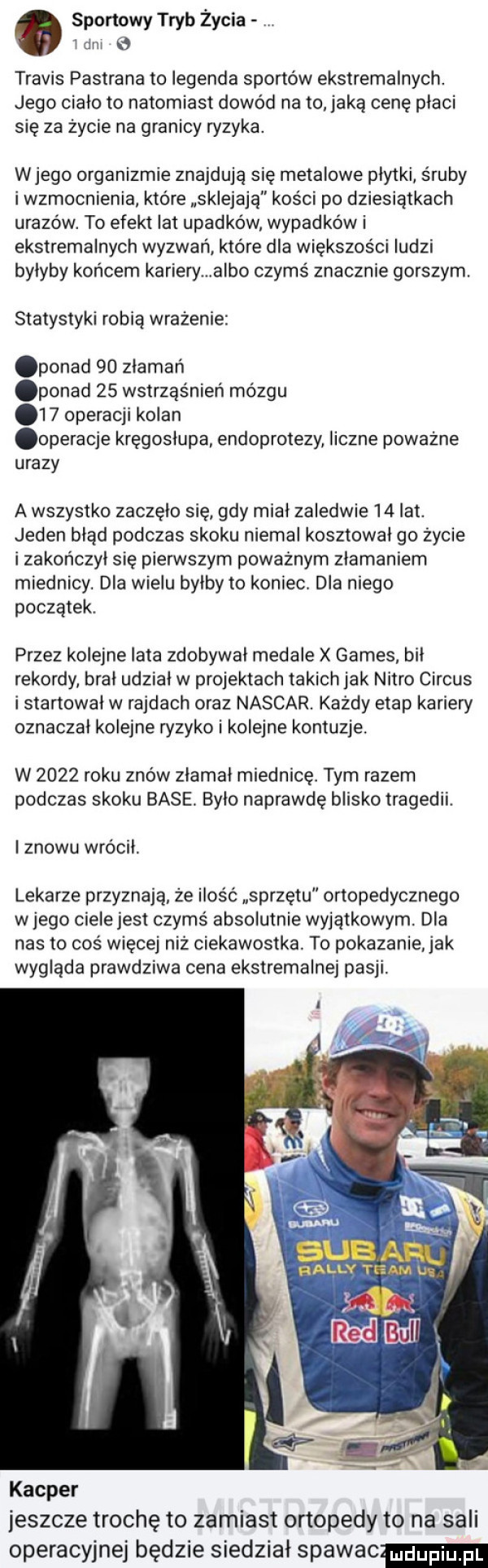 a sportowy tryb życia. w travis pastrana to legenda sportów ekstremalnych. jego ciało to natomiast dowód na to jaką cenę płaci się za życie na granicy ryzyka. wjego organizmie znajdują się metalowe płytki śruby i wzmocnienia które sklejają kości po dziesiątkach urazów. to efekt lat upadków wypadków i ekstremalnych wyzwań które dla większości ludzi bylyby końcem kariery a bo czymś znacznie gorszym. statystyki robią wrażenie ponad    złamań ponad    wstrząśnień mózgu    operacji kolan operacje kregoslupa endoprotezy liczne poważne urazy a wszystko zaczelo sie gdy miał zaledwie    lat. jeden błąd podczas skoku niemal kosztowal go życie i zakończył się pierwszym poważnym złamaniem miednicy. dla wielu bylby to koniec dla niego początek. przez kolejne lata zdobywał medale x gates bil rekordy bral udzial w projektach takich jak nitro cirrus i startowal w rajdach oraz nascar. każdy etap kariery oznaczał kolejne ryzyko i kolejne kontuzje. w      roku znów złamał miednicę. tym razem podczas skoku base. bylo naprawdę blisko tragedii. i znowu wrócił. lekarze przyznają że ilość sprzetu ortopedycznego w jego ciele jest czymś absolutnie wyjątkowym. dla nas to coś więcej niż ciekawostka. to pokazanie jak wygląda prawdziwa cena ekstremalnej pasji. kacper jeszcze trochę to zamiast ortopedy to na sali operacyjnej będzie siedział spawac