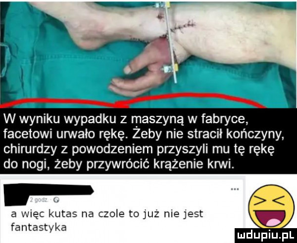 w wyniku wypadku z maszyną w fabryce facetowi urwało rękę. żeby nie stracił kończyny chirurdzy z powodzeniem przyszyli mu tę rękę do nogi zeby przywrócić krążenie krwi. a więc kutas na czele to juz nie jest fantastyka r