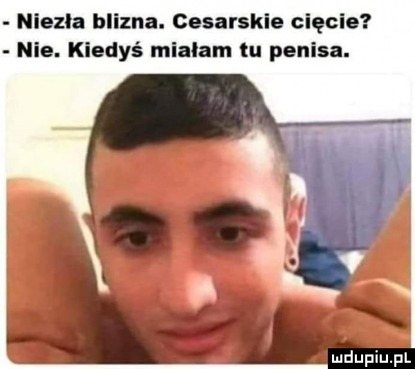 niezła blizna. cesarskie cięcie nie. kiedyś miałam tu penisa