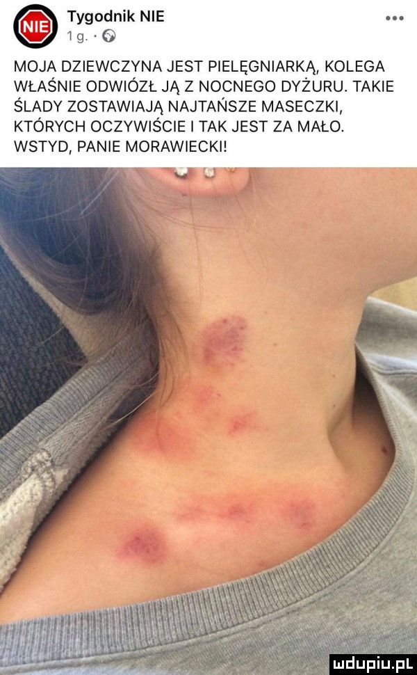 tygodnik nie ig. q moja dziewczyna jest pielęgniarką kolega właśnie odwiózł ją z nocnego dyżuru. takie ślady zostawiają najtansze maseczki których oczywiście i tak jest za mało. wstyd panie morawiecki s x e